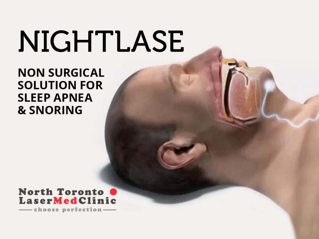 NightLase Sleep Apnea North Toronto Laser Med Clinic