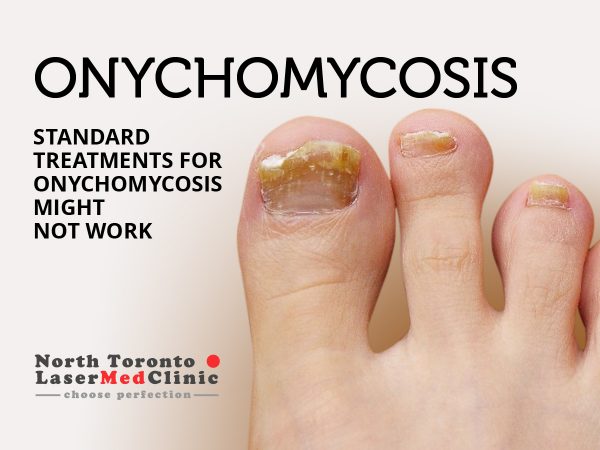 Standard Treatments for Onychomycosis Might Not Work | North Toronto ...